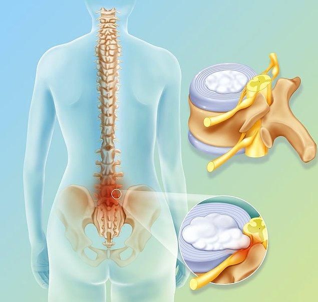 Bel Fıtığı Hangi Organlara Zarar Verir? 