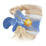 Bel Fıtığı Emarı Kaç Dakika Sürer?