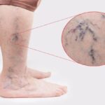 Bel Fıtığı Emarı Kaç Dakika Sürer?