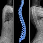 Bel Fıtığı Varis Yapar Mı?